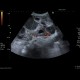 Retroperitoneal sarcoma, sarcoma of retroperitoneum, biopsy, CT guided biopsy: US - Ultrasound